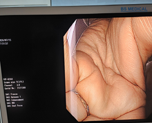 Load image into Gallery viewer, Used Olympus GIF-Q260 Video Gastroscope | Outer-Sheath Peeling
